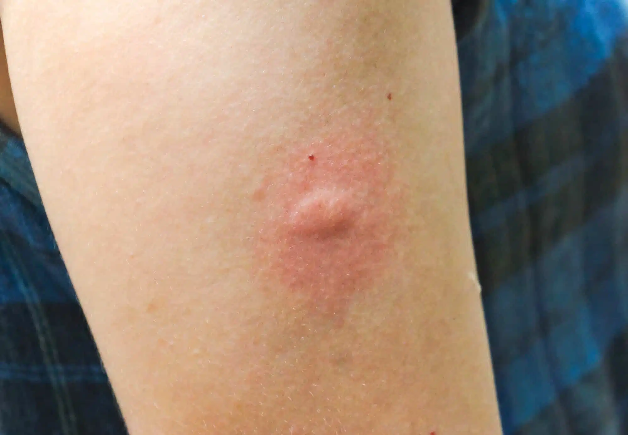 Allergic reaction to mosquito bites