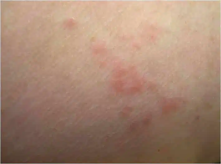 bed bug bites on skin