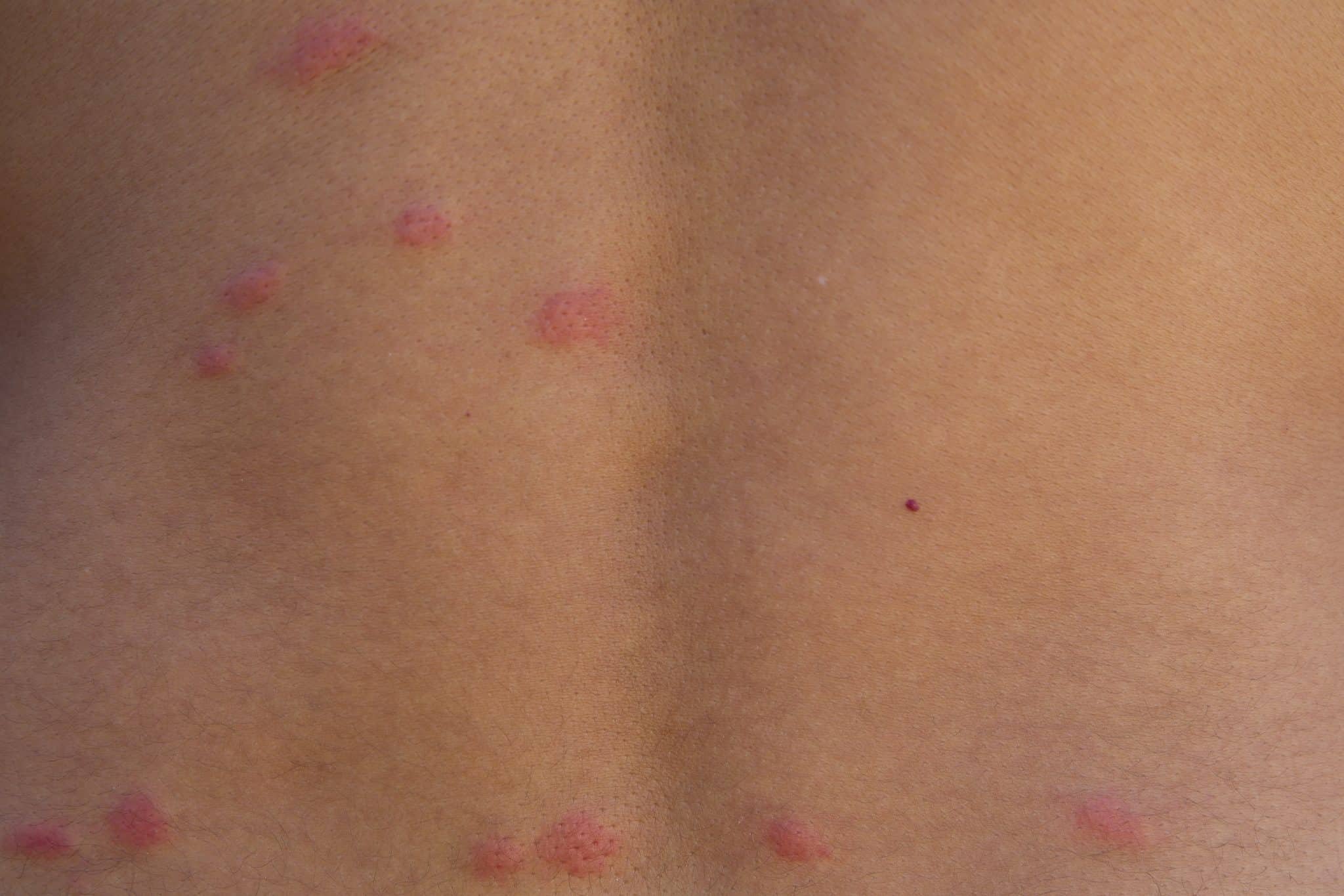 flea bites on skin