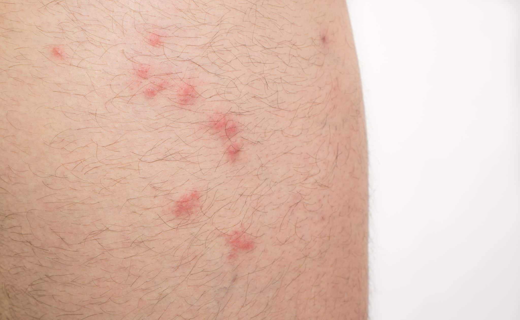 flea bites on leg
