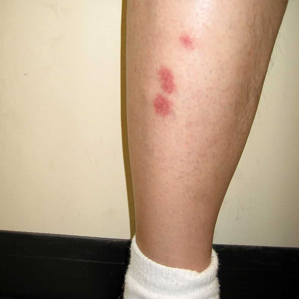 bug bites on leg