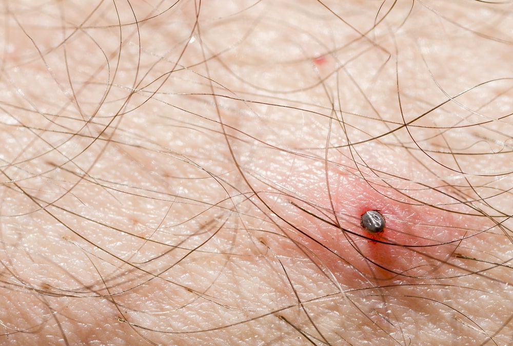 tick attached to skin