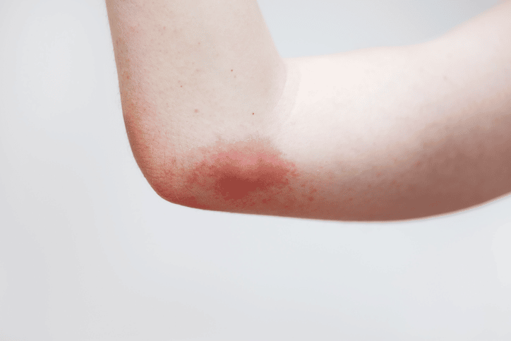 wasp sting on arm