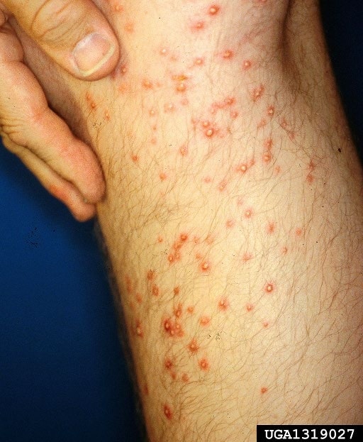 A badly stung arm by fire ants.