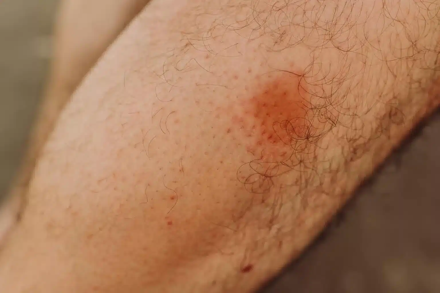 Red swollen bite mark on human leg caused by a black fly