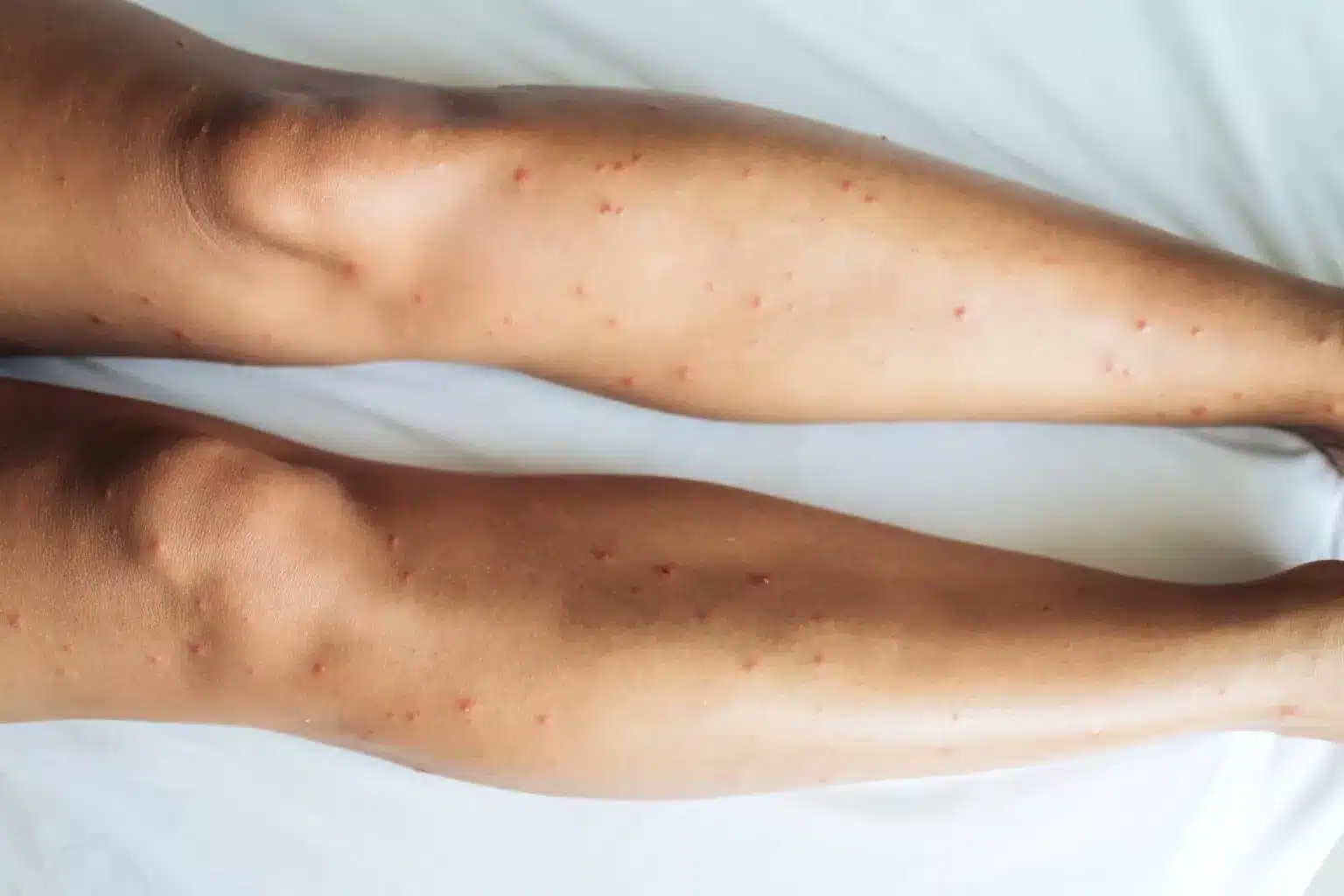 Multiple red bite marks on legs caused by sand flies