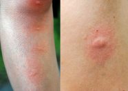 Mosquito Bites On Humans Pictures Treatment And Prevention Mosquito Bites On Humans Pictures Treatment And Prevention