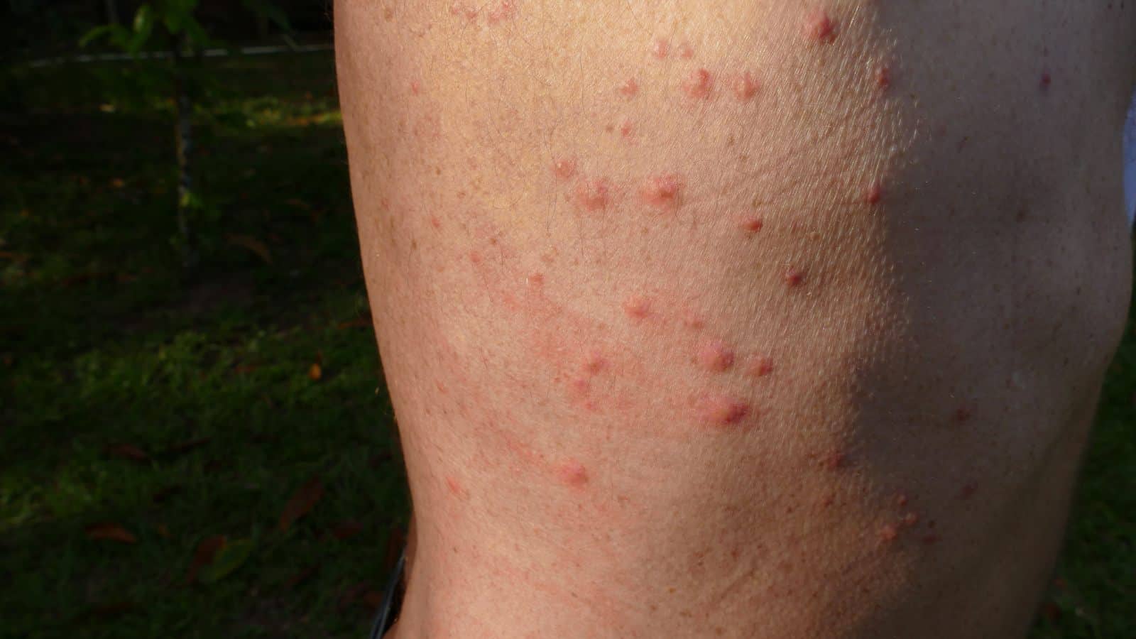 skin reaction to bed bug bites