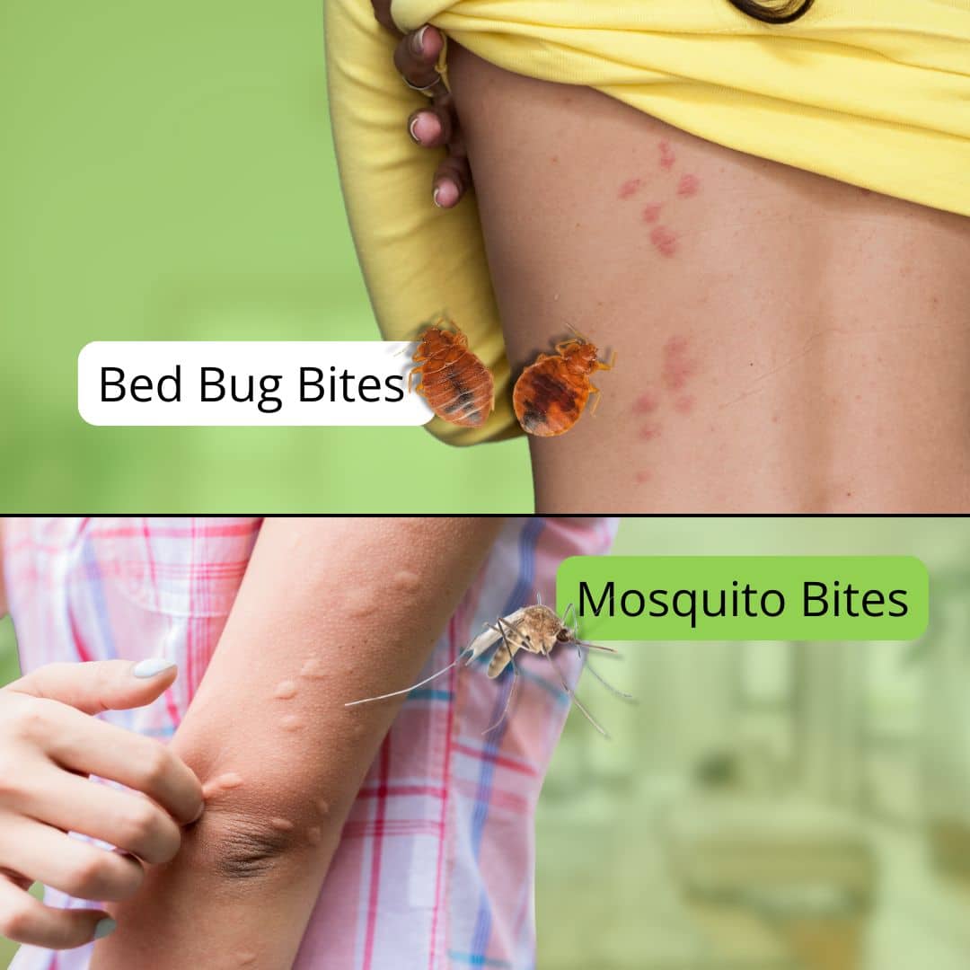 bed bug bites